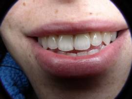 כתר E-max על שתל קדמי